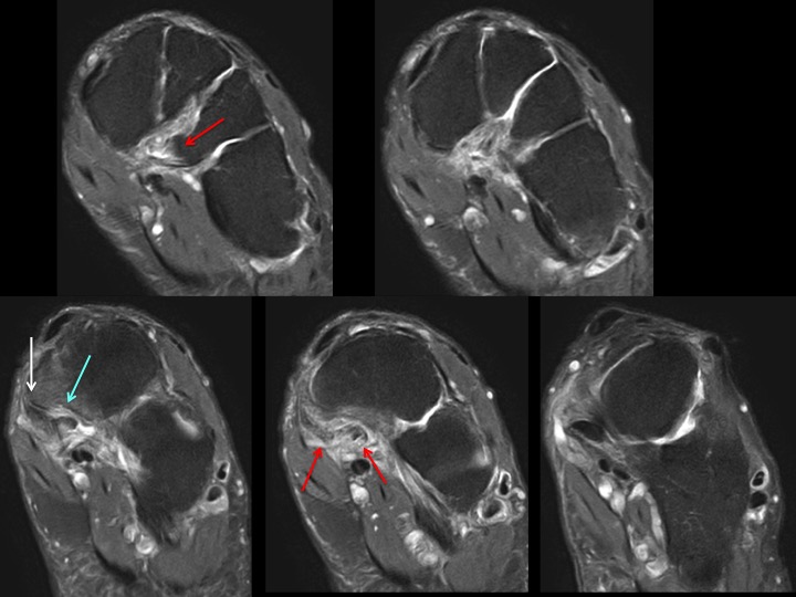 Figure 3 for case posterior tibial tendon ( RID3194 )